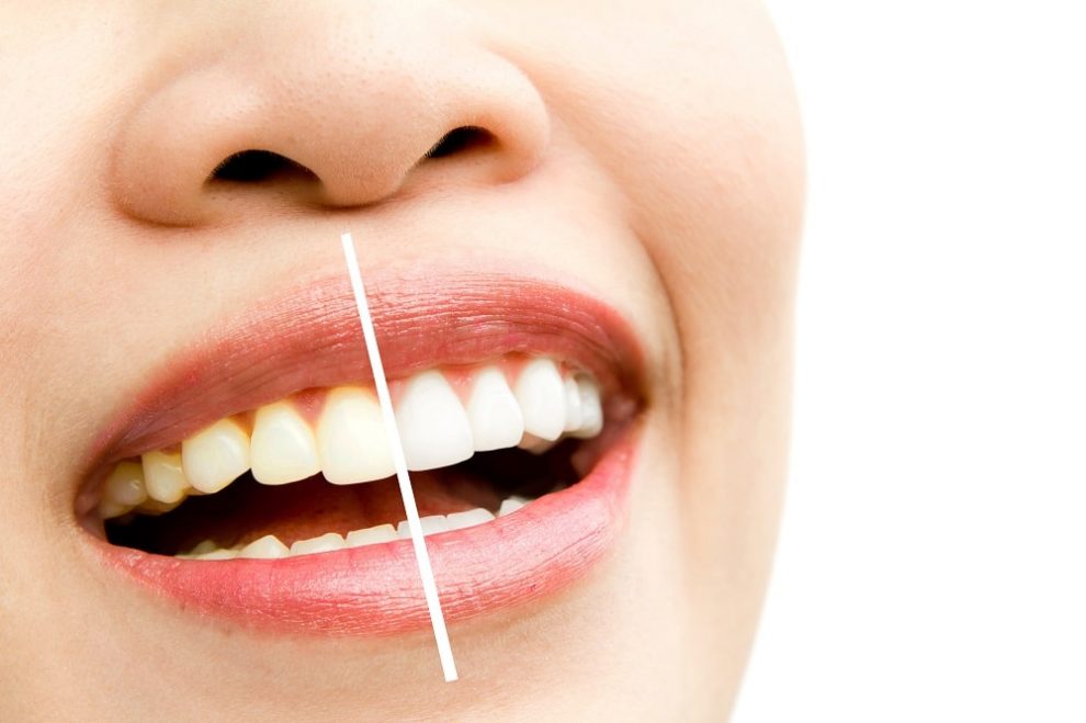 articolo sbiancamento dentale