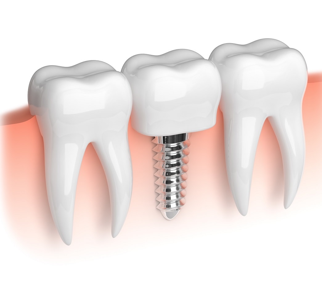 Impianti a connessione conica