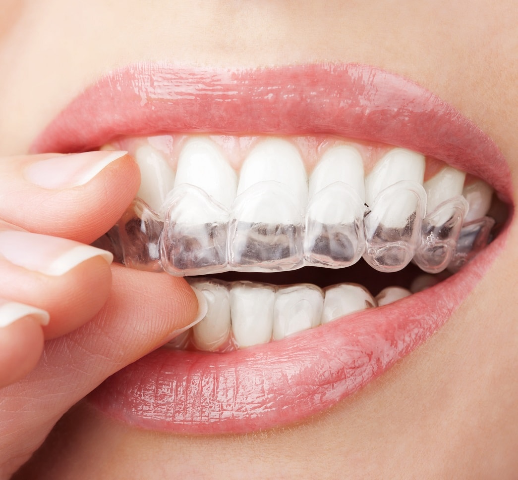 Invisalign
