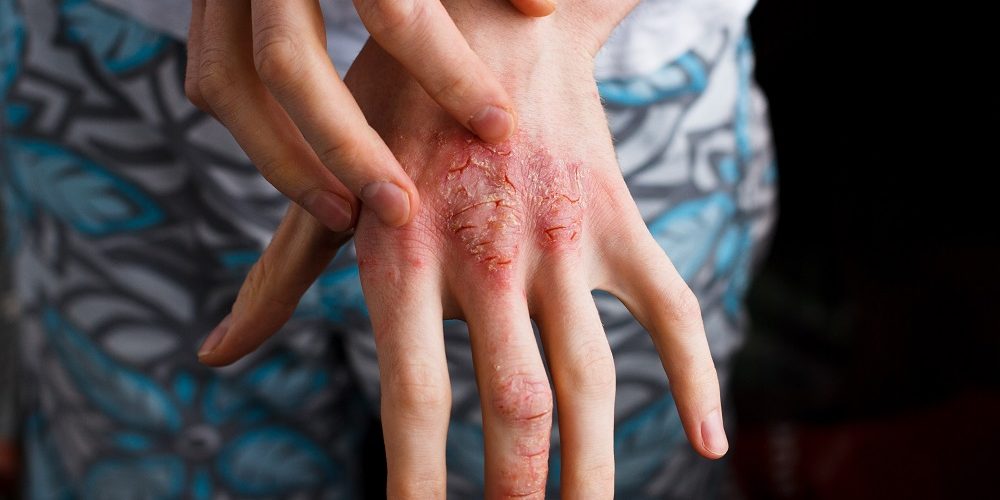 Psoriasi