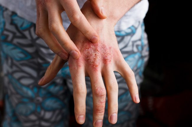 Psoriasi