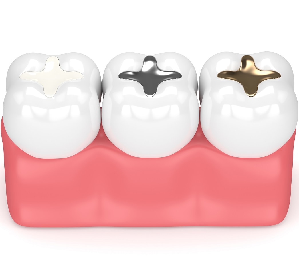 Ricostruzioni-Otturazioni