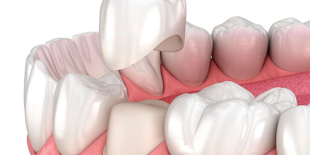 corona-dente