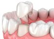 corona-dente