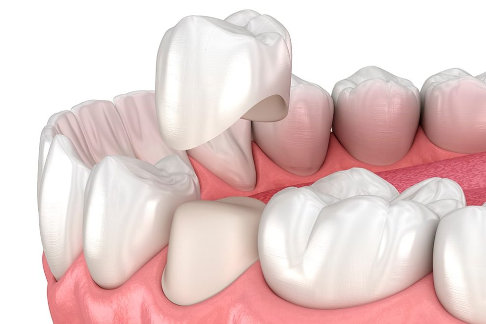 corona-dente
