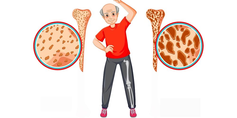 osteoporosi osteoporosi