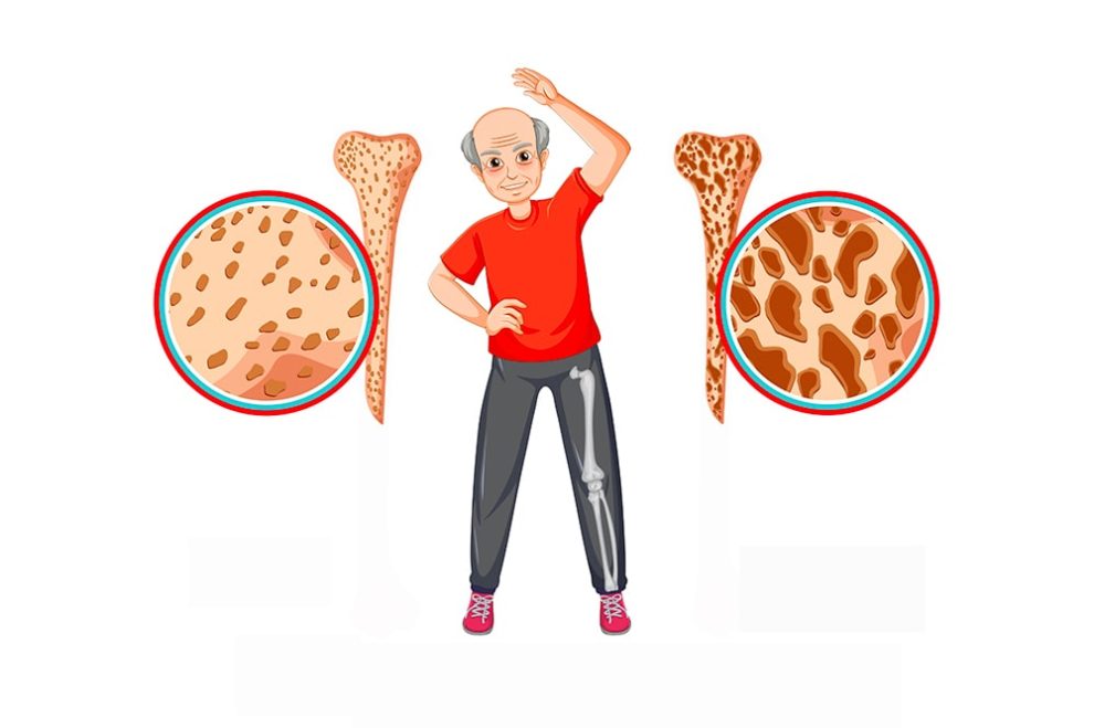 osteoporosi