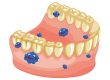 placca-dentale